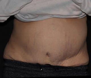 Vanquish Before & After Gallery - Patient 697781 - Image 2