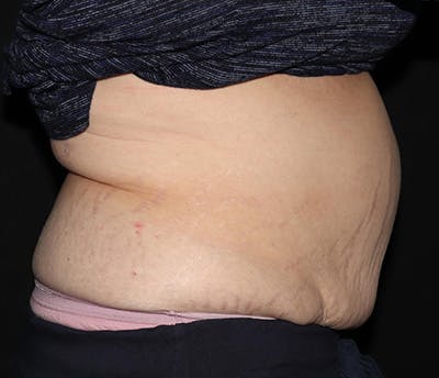 Vanquish Before & After Gallery - Patient 697781 - Image 3