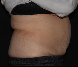 Vanquish Before & After Gallery - Patient 697781 - Image 4