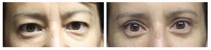 Before and After Eyelid Surgery