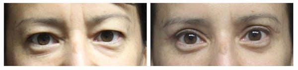 Before and After Eyelid Surgery