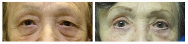 Before and After Eyelid Surgery