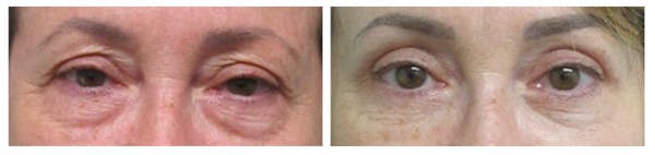 Before and After Eyelid Surgery