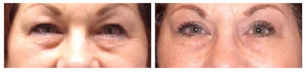 Before and After Eyelid Surgery