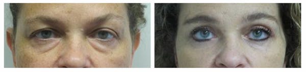 Before and After Eyelid Surgery