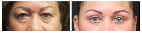 Before and After Eyelid Surgery