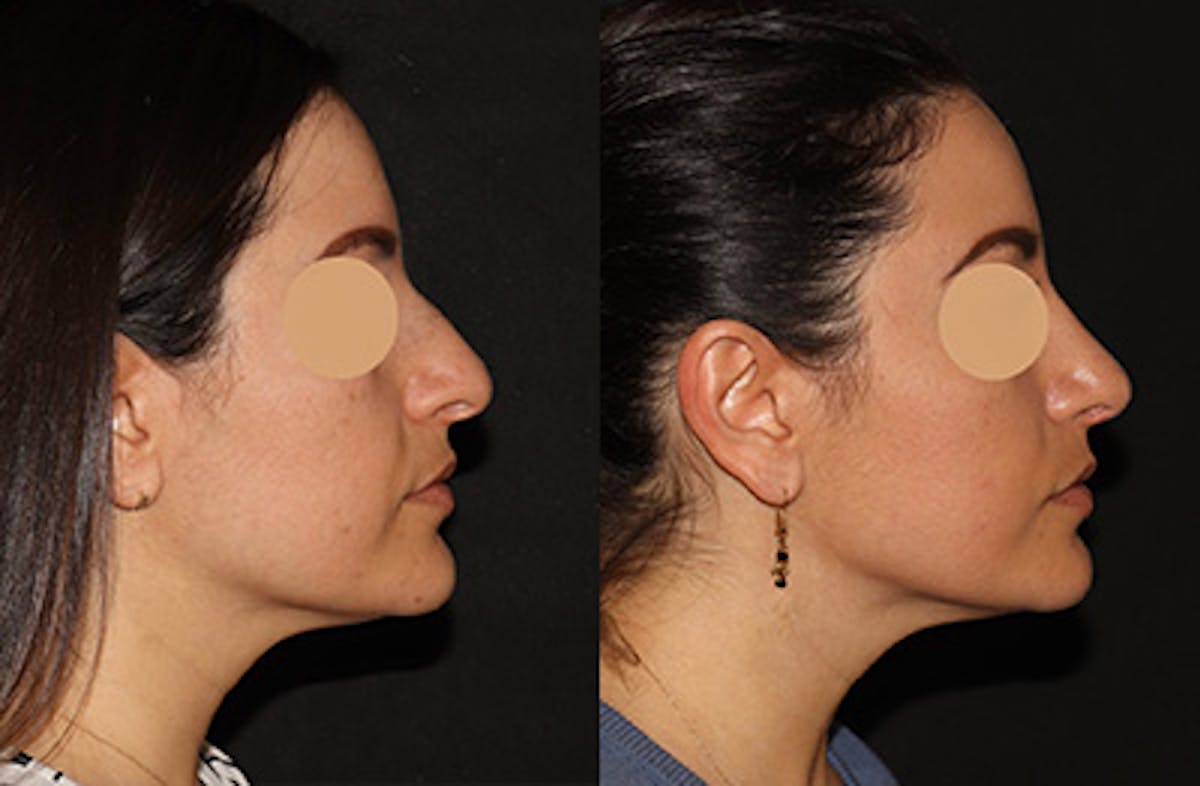 Rhinoplasty Before & After Gallery - Patient 258589 - Image 1