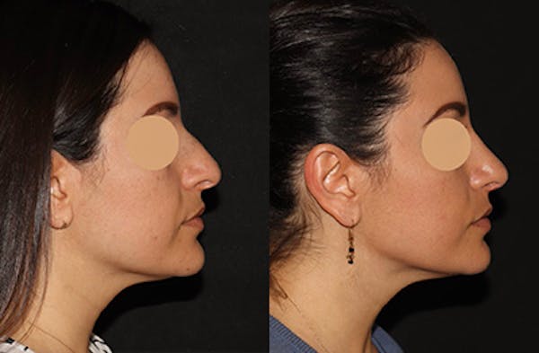 Rhinoplasty Before & After Gallery - Patient 258589 - Image 1