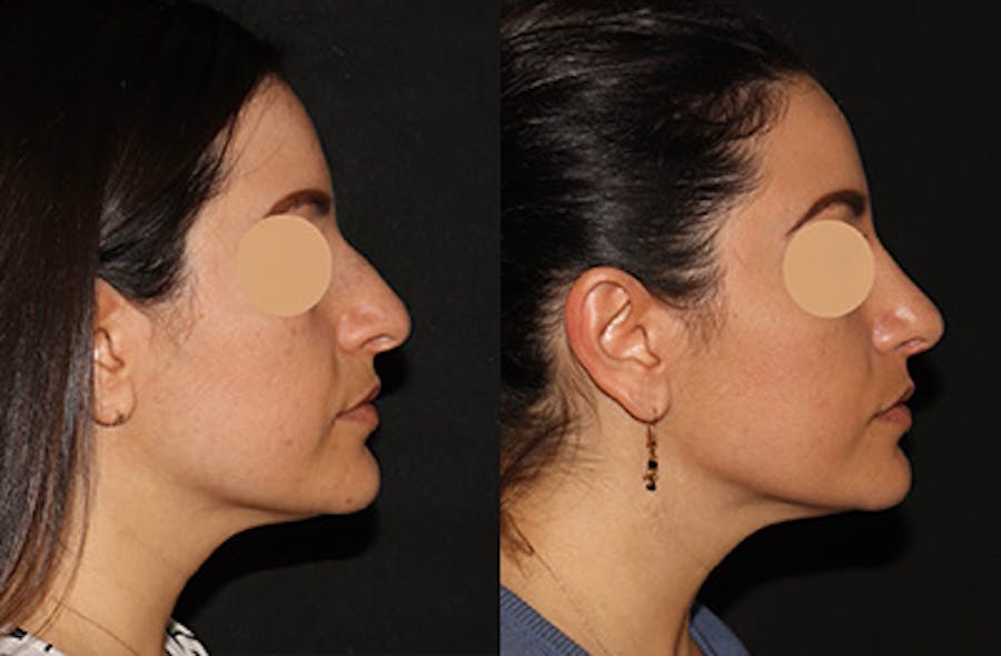 Rhinoplasty Before & After Gallery - Patient 258589 - Image 1