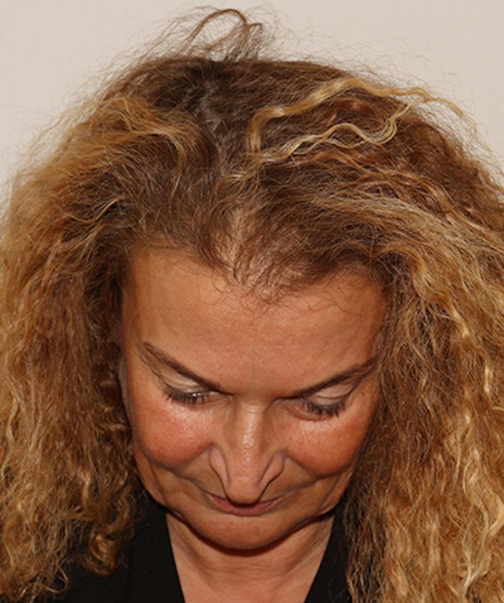 Non Surgical Hair Restoration Before & After Gallery - Patient 398256 - Image 1