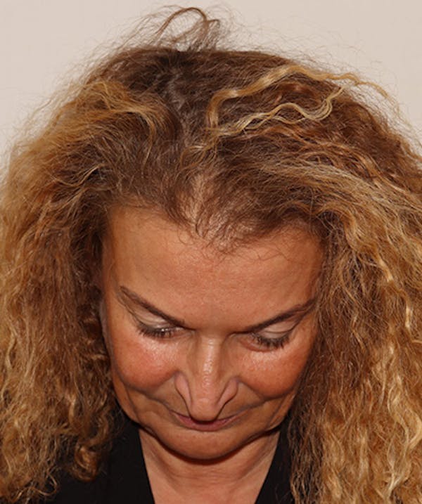 Non Surgical Hair Restoration Before & After Gallery - Patient 398256 - Image 1