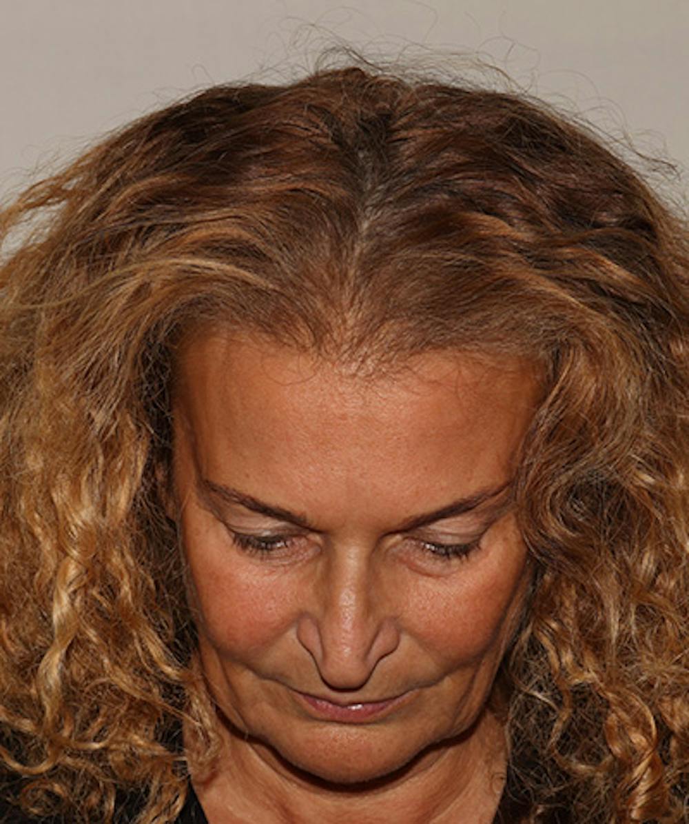 Non Surgical Hair Restoration Before & After Gallery - Patient 398256 - Image 2