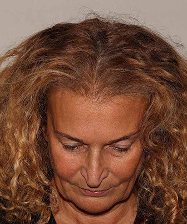 Non Surgical Hair Restoration Before & After Gallery - Patient 398256 - Image 2