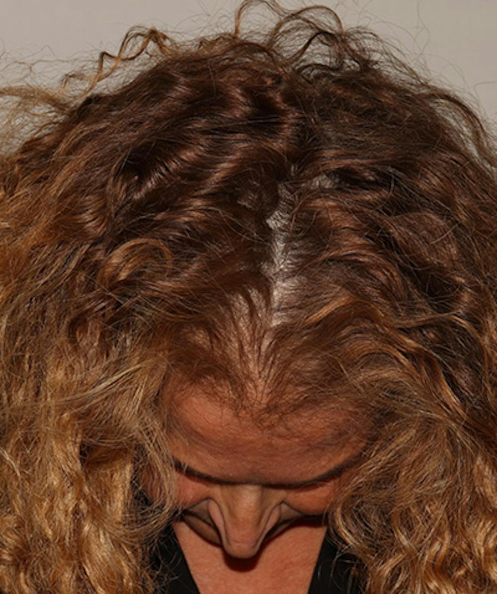 Non Surgical Hair Restoration Before & After Gallery - Patient 398256 - Image 3