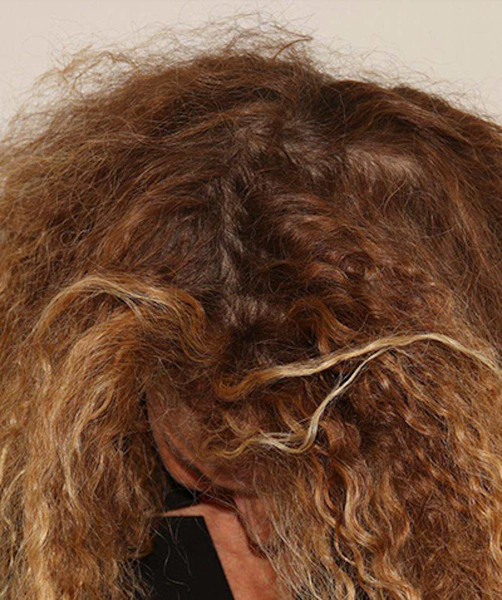 Non Surgical Hair Restoration Before & After Gallery - Patient 398256 - Image 4