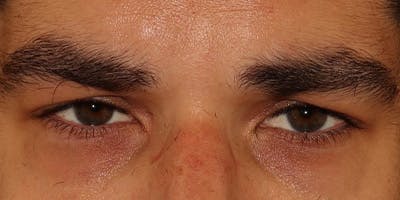  Blepharoplasty Before & After Gallery - Patient 950867 - Image 1