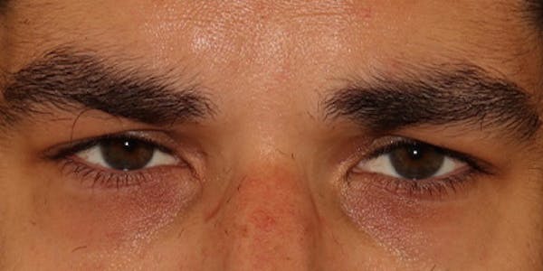  Blepharoplasty Before & After Gallery - Patient 950867 - Image 1