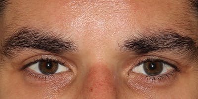  Blepharoplasty Before & After Gallery - Patient 950867 - Image 2