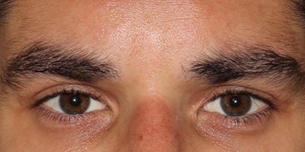  Blepharoplasty Before & After Gallery - Patient 950867 - Image 2