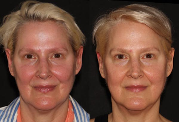 EMFACE Before & After Gallery - Patient 128773 - Image 1