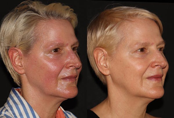 EMFACE Before & After Gallery - Patient 128773 - Image 2