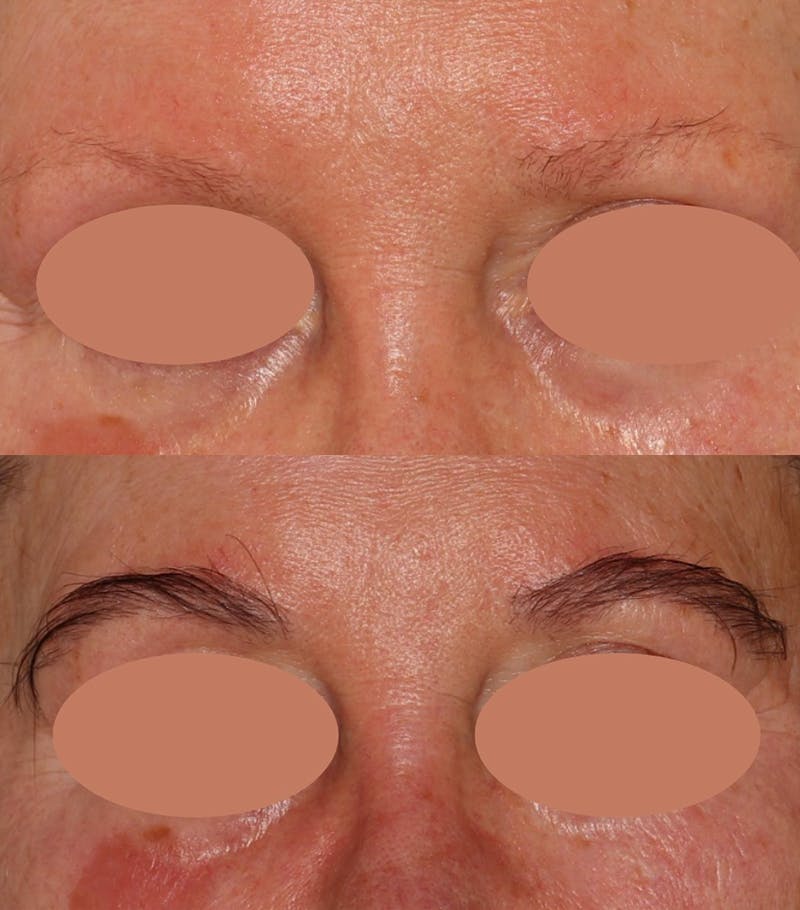 Eyebrow Transplant Before & After Gallery - Patient 231488 - Image 1