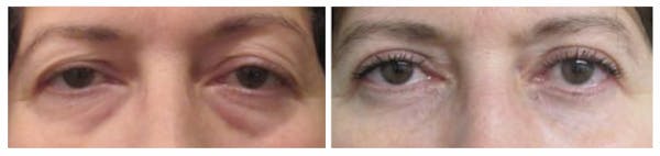 Before and After Eyelid Surgery