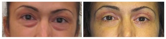 Before and After Eyelid Surgery