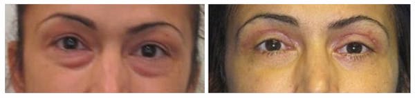 Before and After Eyelid Surgery