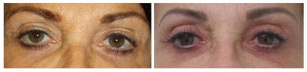 Before and After Eyelid Surgery
