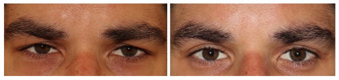 Before and After Eyelid Surgery
