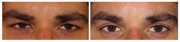 Before and After Eyelid Surgery