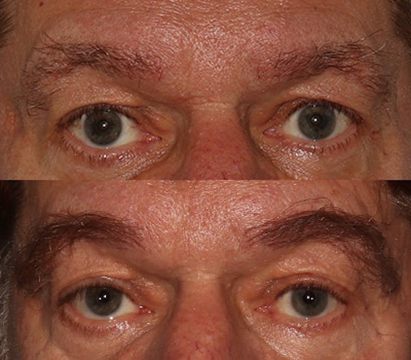 Eyebrow Transplant Before & After Gallery - Patient 286920 - Image 1