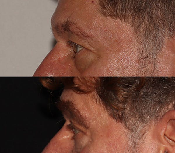 Eyebrow Transplant Before & After Gallery - Patient 286920 - Image 5