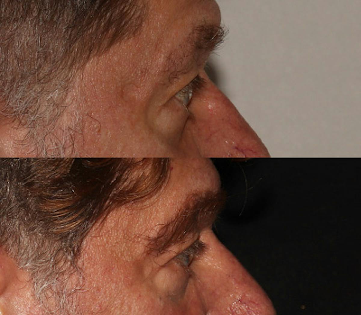 Eyebrow Transplant Before & After Gallery - Patient 286920 - Image 3