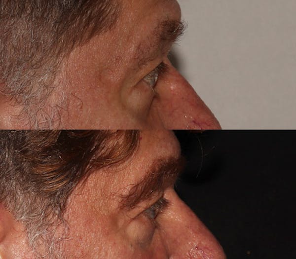 Eyebrow Transplant Before & After Gallery - Patient 286920 - Image 3