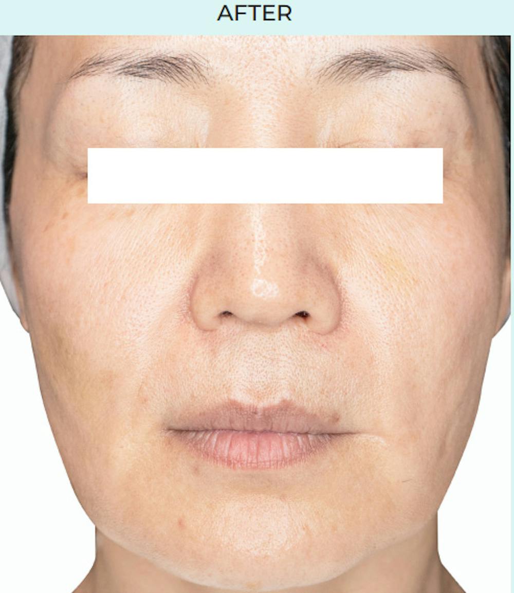 Rejuran Before & After Gallery - Patient 349016 - Image 2