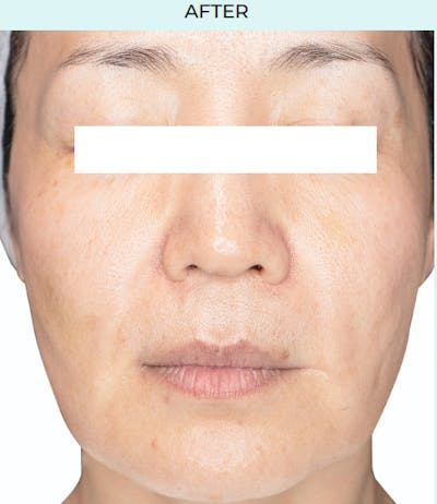 Rejuran Before & After Gallery - Patient 349016 - Image 2