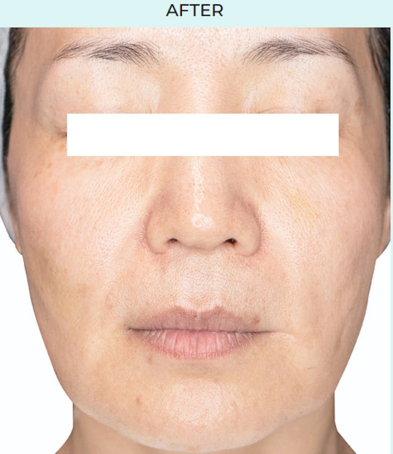 Rejuran Before & After Gallery - Patient 349016 - Image 2