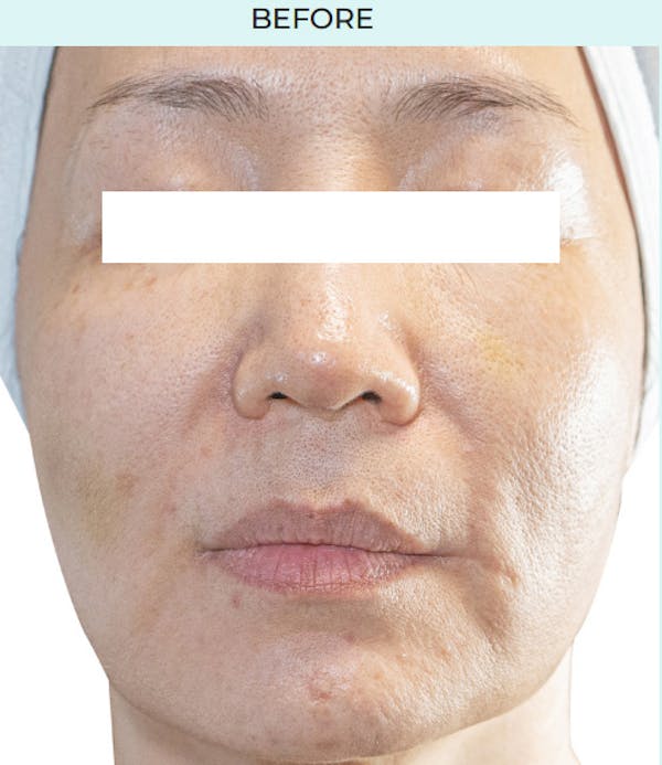 Rejuran Before & After Gallery - Patient 349016 - Image 1