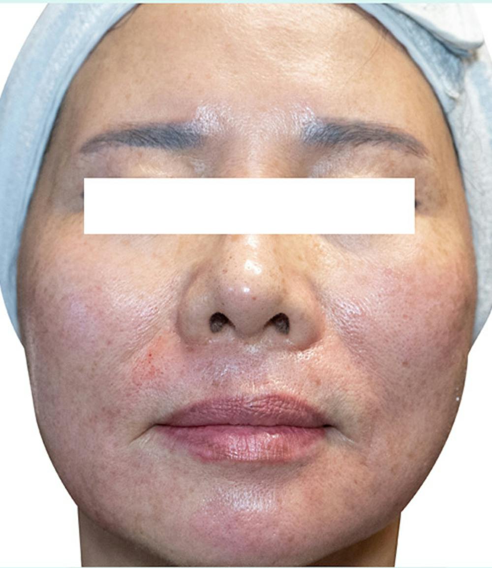 Rejuran Before & After Gallery - Patient 266258 - Image 1