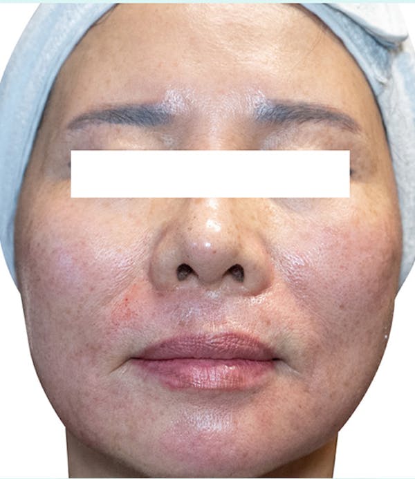 Rejuran Before & After Gallery - Patient 266258 - Image 1