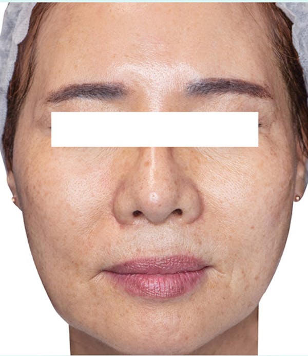 Rejuran Before & After Gallery - Patient 266258 - Image 2