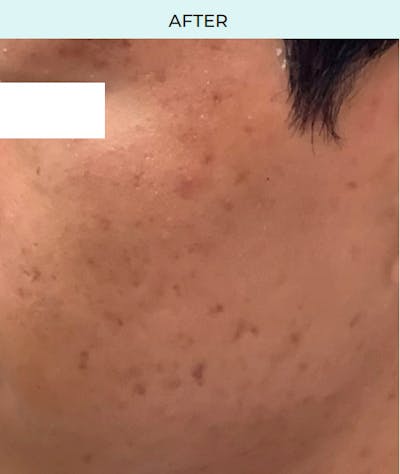 Rejuran Before & After Gallery - Patient 267033 - Image 2