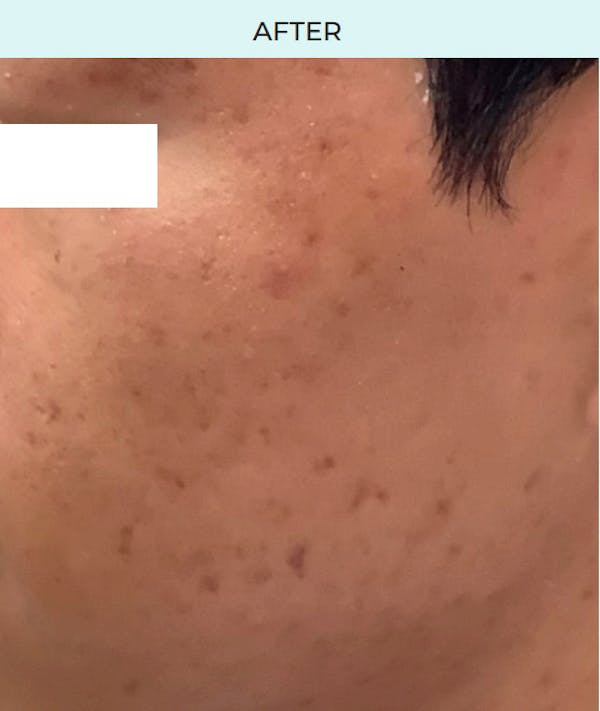 Rejuran Before & After Gallery - Patient 267033 - Image 2