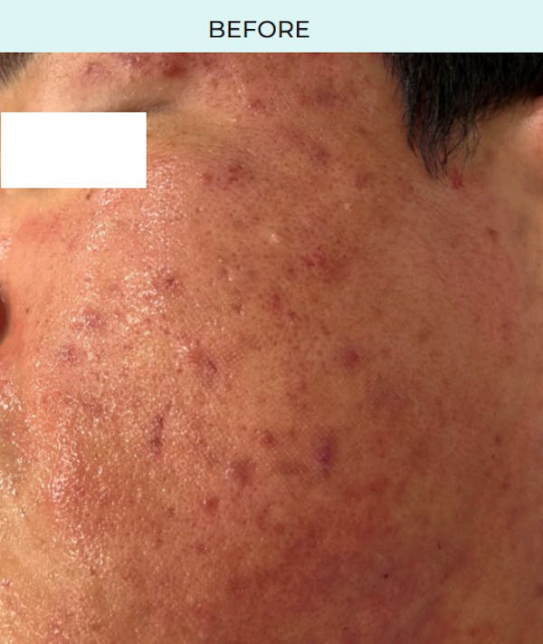 Rejuran Before & After Gallery - Patient 267033 - Image 1