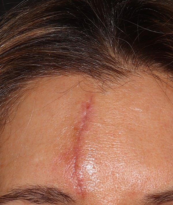 Microneedling Before & After Gallery - Patient 638877 - Image 1