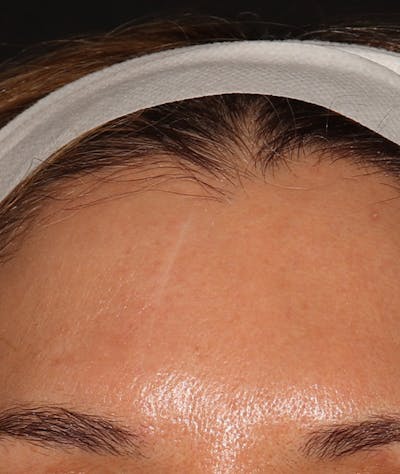 Microneedling Before & After Gallery - Patient 638877 - Image 2