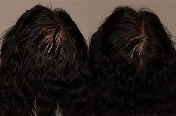 Hair Transplant Before & After Gallery - Patient 421868 - Image 1