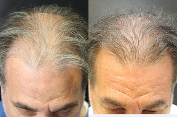 Hair Transplant Before & After Gallery - Patient 54187631 - Image 1
